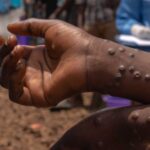 Mpox